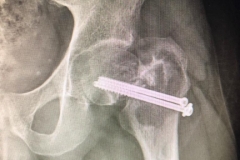 Kalçada kemik kistine bağlı kırık sonrası kaynamayan hastanın revizyonu